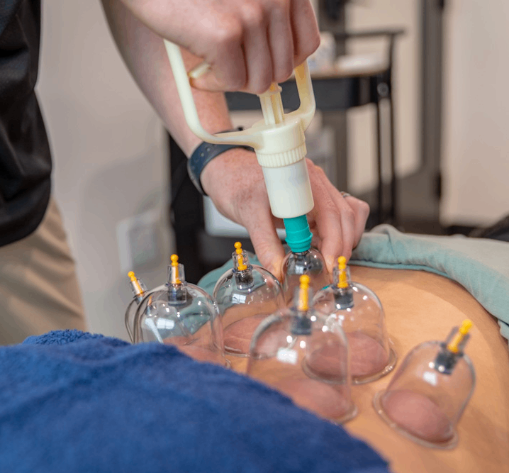 Experience relief and relaxation with our specialized cupping therapy services.