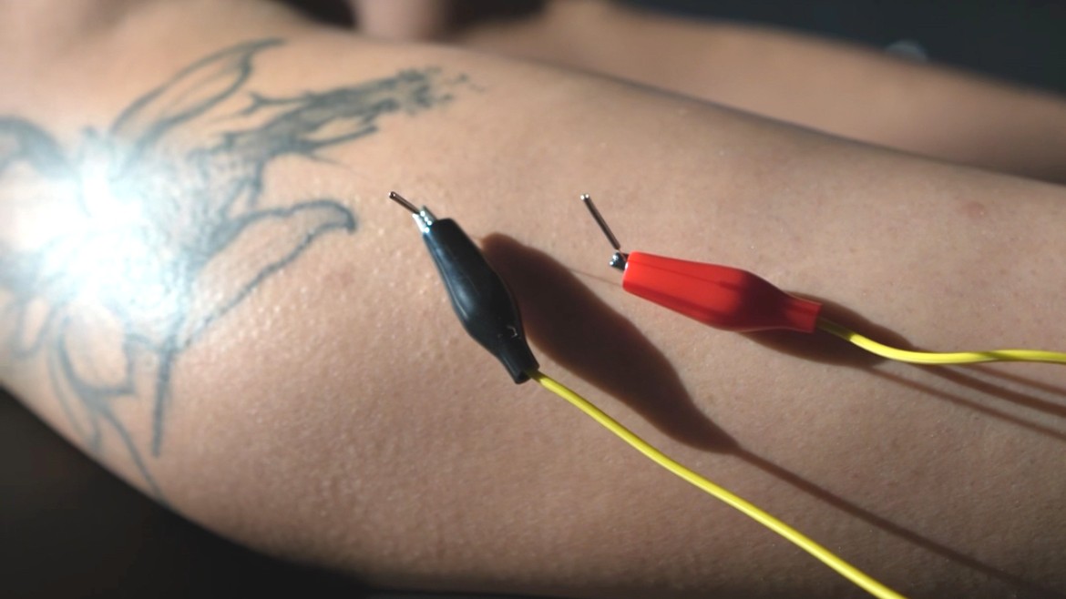 What Is Dry Needling With Electrical Stimulation?