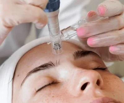 microneedling