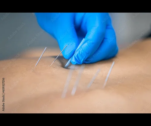 <p>Dry Needling</p>