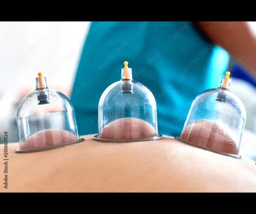 <p>Cupping</p>